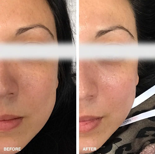 Anti Aging TE360 - Thermal TE360 Radio Frequency, before and after picture for a client, right side of face