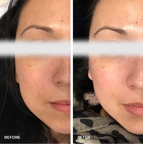 Anti Aging TE360 - Thermal TE360 Radio Frequency, before and after picture for a client, left side of face